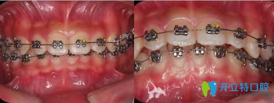 我在廈門康德佳口腔做牙齒矯正過程 我在廈門康德佳口腔做牙齒矯正過程