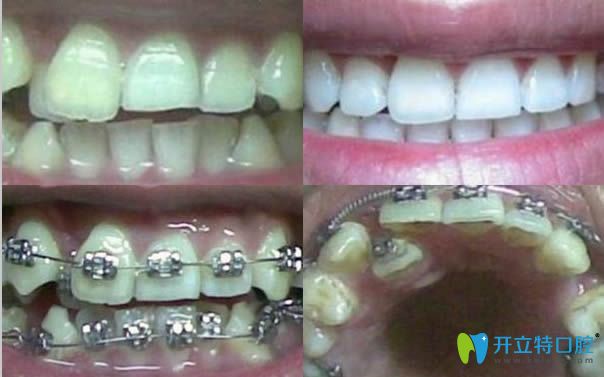 青島維樂口腔牙齒正畸效果對比圖