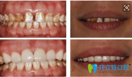 重度氟斑牙選擇美容冠后的對比效果圖