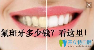 治療氟斑牙的價(jià)格需要多少錢
