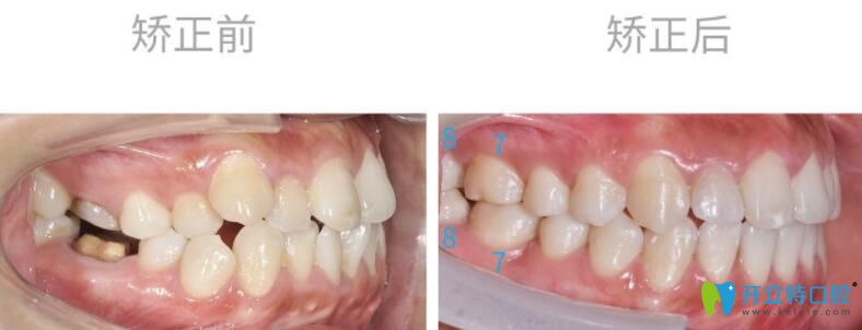 智齒矯正前后側(cè)面圖