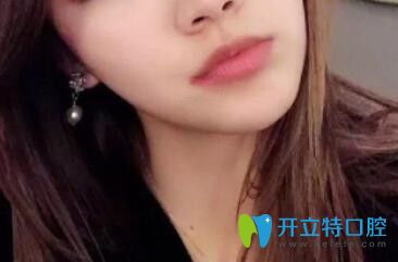 博思美隱形矯正效果圖