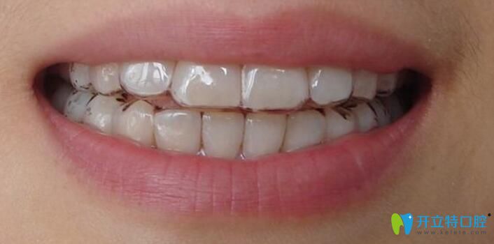 博思美隱形矯正的適應(yīng)癥狀