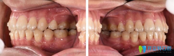 博思美隱形矯正效果好不好？來看看小姐姐的案例