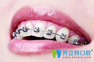 牙醫(yī)否定矯正牙齒老了會(huì)容易掉牙，原因在此