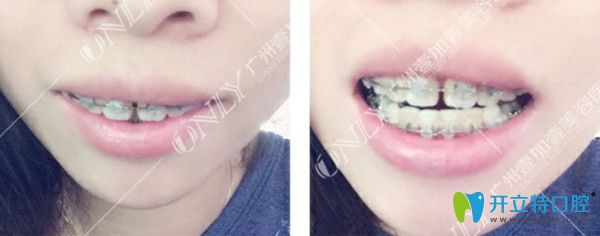 牙齒稀疏矯正前的照片