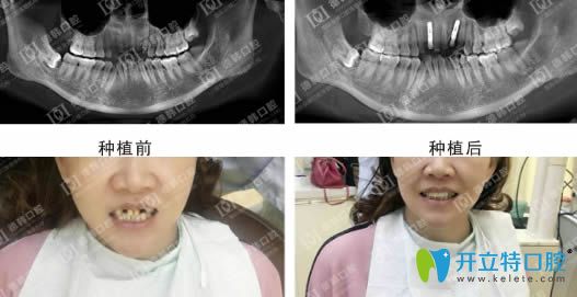 德韓口腔種植牙效果前后對比圖