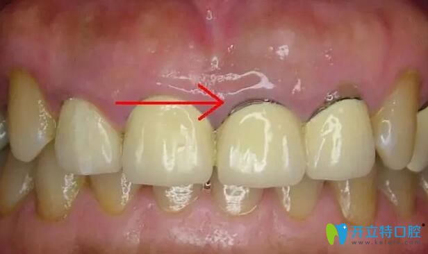 烤瓷牙牙齦黑線