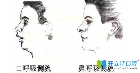 引起牙弓狹窄的原因有哪些