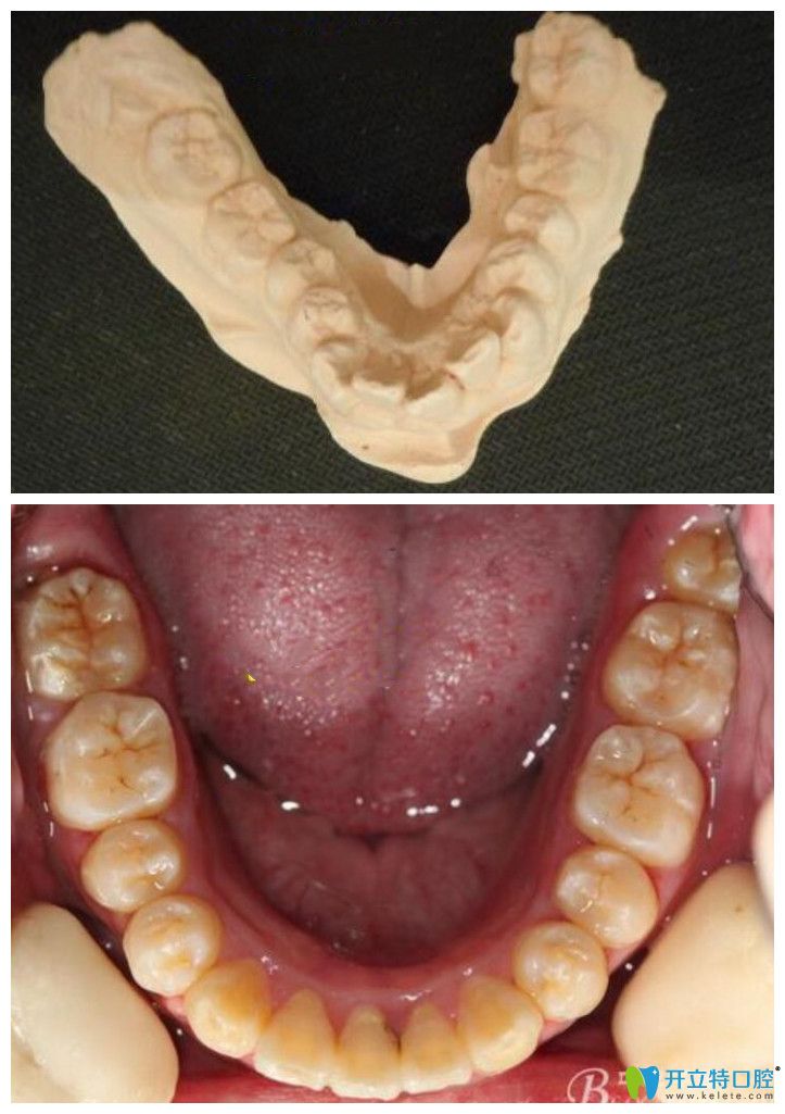 牙弓狹窄怎么矯正