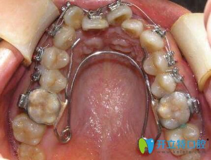 在了解牙弓狹窄怎么矯正前，你還要知道這些……