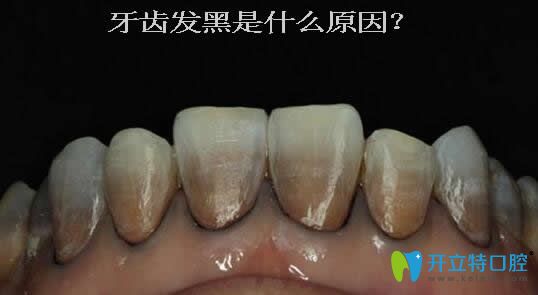 一次性告訴你:牙齒發(fā)黑是什么原因？可能與蛀牙無(wú)關(guān)