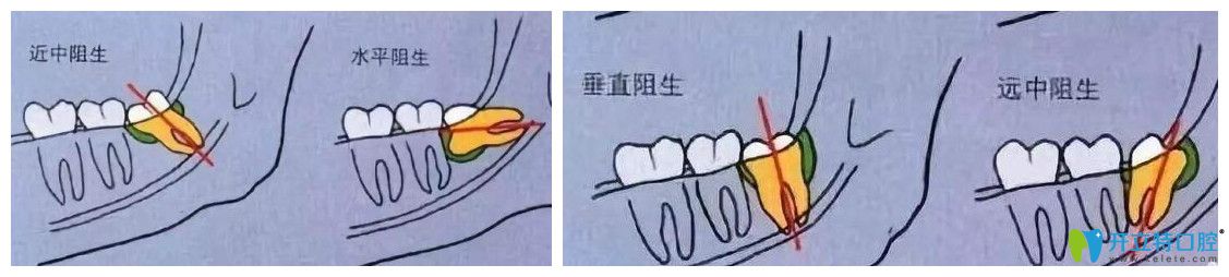 牙齒越來(lái)越往外突出原因