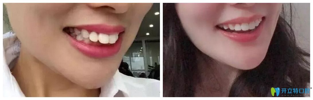 牙齒外翻矯正耗時快3年，才終于取得成效