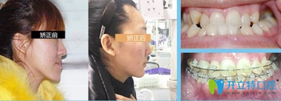 東莞好佰年成人地包天矯正案例及臉型變化對(duì)比圖