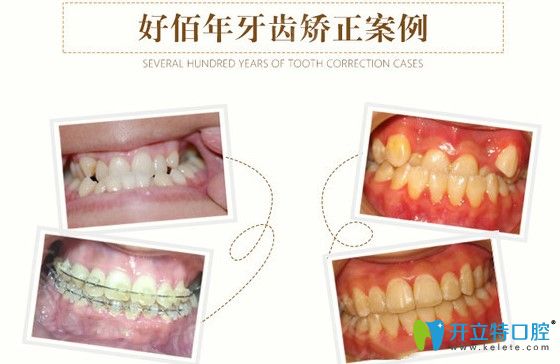 兒童地包天矯正及青少年反頜矯正案例圖