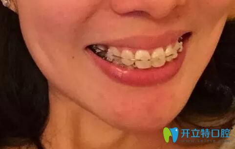 拆掉墊高的樹脂后，發(fā)現(xiàn)咬合全錯(cuò)位了