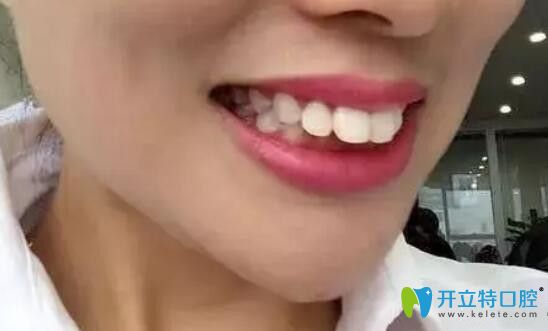 矯正前，上排門牙外凸