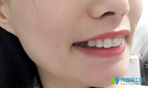 牙根短做了牙齒矯正