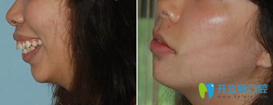 南昌拜博口腔齙牙正畸療效