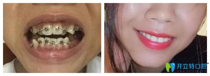 南昌德韓口腔牙齒矯正實例