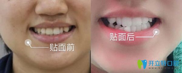 牙齒美容修復(fù)前后變化圖