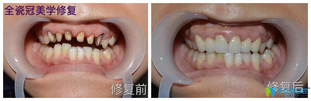 逸盛口腔口腔烤瓷牙失敗全瓷牙修復(fù)案例前后效果對(duì)比