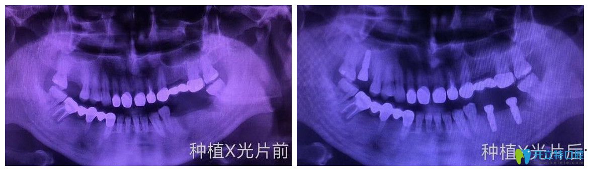 逸盛口腔口腔多顆牙缺失即刻種植案例