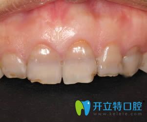 衡陽(yáng)美萊口腔的超薄瓷貼面改善了我的四環(huán)素牙黃牙