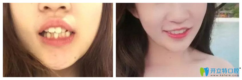 案例來驗證泗洪眾迪口腔王菲菲牙齒矯正怎么樣