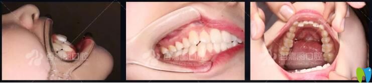 牙齒擁擠不齊矯正案例