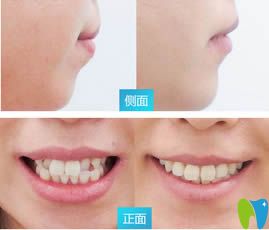 衡陽美萊口腔黃安醫(yī)生牙齒矯正效果對比圖