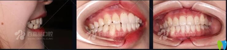 沈陽百嘉麗口腔正畸案例來驗證怎么樣