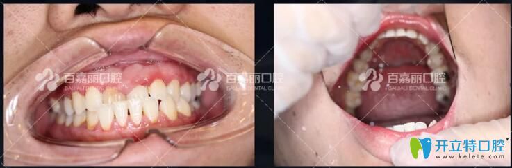 隱適美隱形矯正成人地包天矯正案例