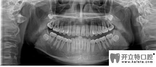 牙齒全景片