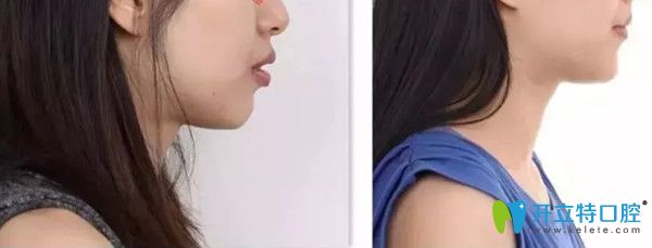 口腔正畸前后變化圖