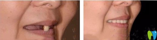 張阿姨全口種植牙對比照片