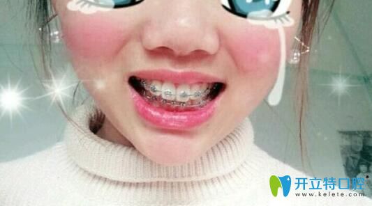 大兔牙牙齒矯正62天