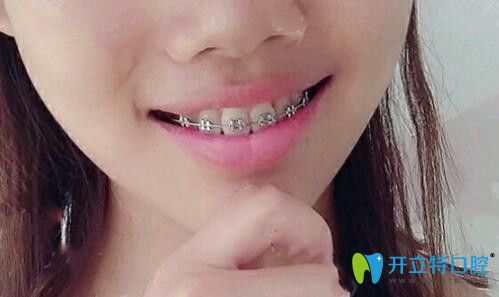 戴金屬牙套100天牙齒變化圖