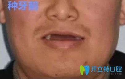 張先生做過(guò)全口種植牙后的照片 張先生做過(guò)全口種植牙后的照片