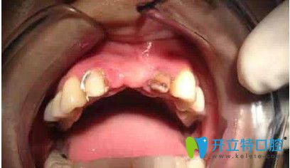 劉女士做種植牙前的照片 劉女士做種植牙前的照片