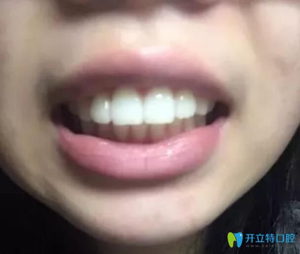 骨性+牙性齙牙在太原華美矯做了金屬鋼絲矯正，現(xiàn)下牙套了