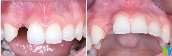 拔出牙根后的缺牙情況