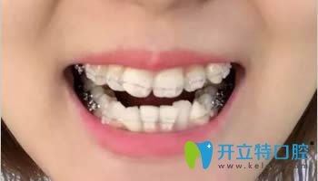 連江縣胡明輝口腔牙齒正畸術(shù)中照