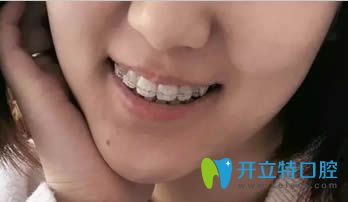 連江縣明輝口腔牙齒正畸18個(gè)月效果圖