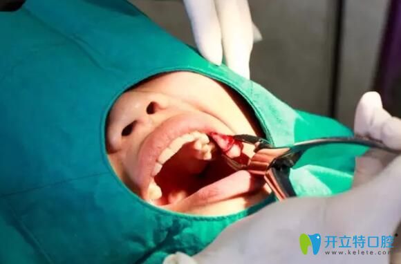 拔牙后預(yù)防發(fā)炎感染注意事項(xiàng)