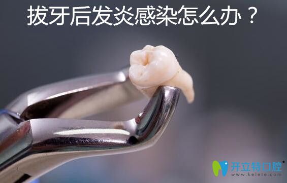 拔牙后發(fā)炎感染了怎么辦？感染癥狀有哪些你知道嗎？