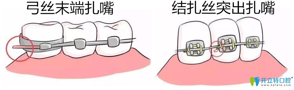 牙齒矯正鋼絲扎嘴怎么辦