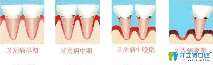 解答牙周病怎么治療?牙周病的費(fèi)用需要多少錢?