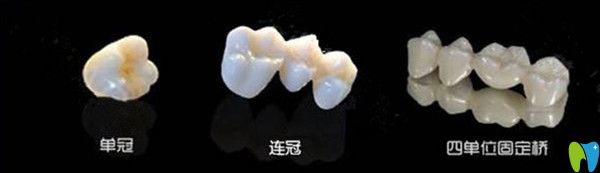 當牙齒缺損時，選擇單冠好還是連冠好？